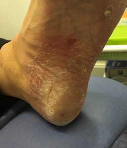 A patient with a foot infection