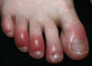 A patient with chilblains on the toes