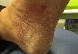 A patient with a foot infection