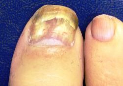 A fungal nail problem